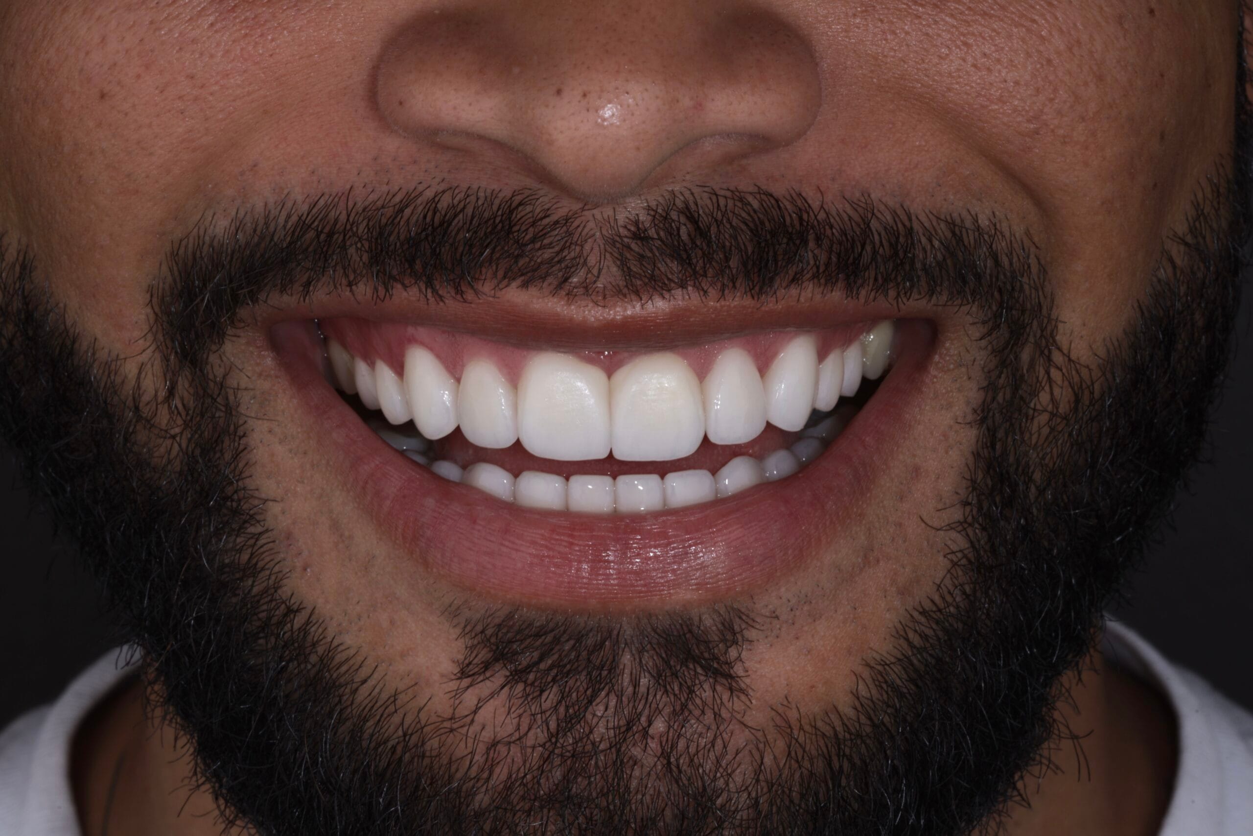 DENTAL GAPS TO PORCELAIN VENEERS